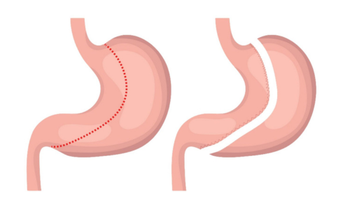 gastric sleeve recovery day by day